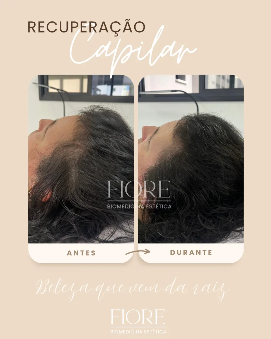 Antes e depois de recuperação capilar na Fiore