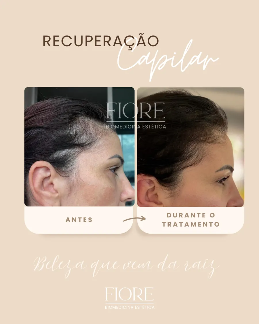 Antes e depois de recuperação capilar na Fiore