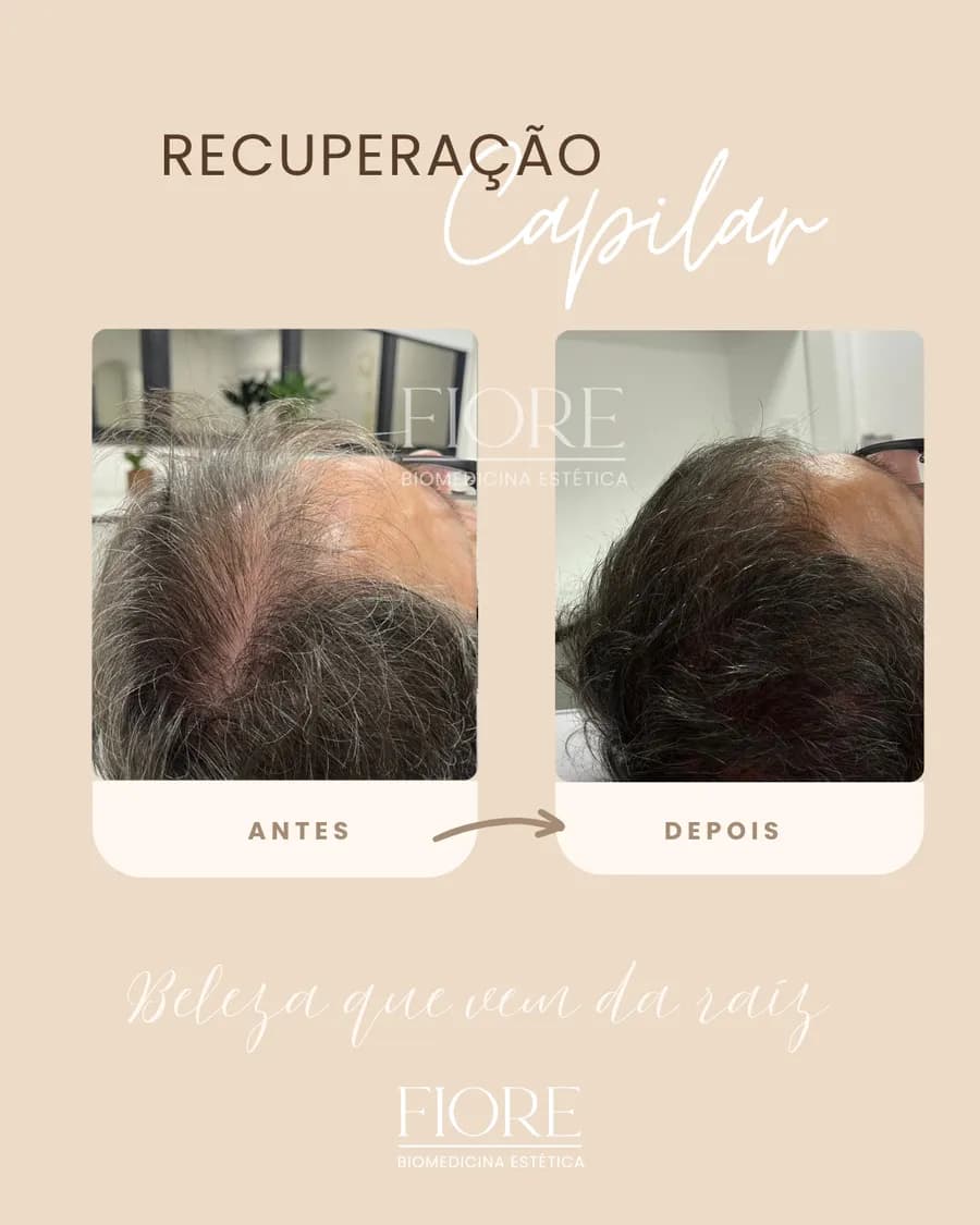 Antes e depois de recuperação capilar na Fiore