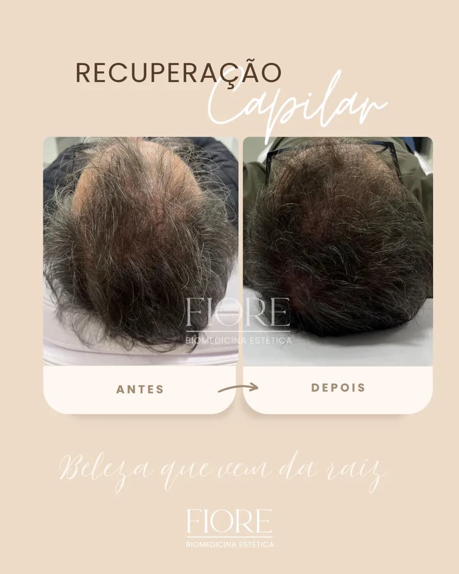 Queda capilar intensa: fios na mão antes e depois do tratamento